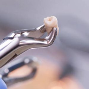 wisdom tooth removal