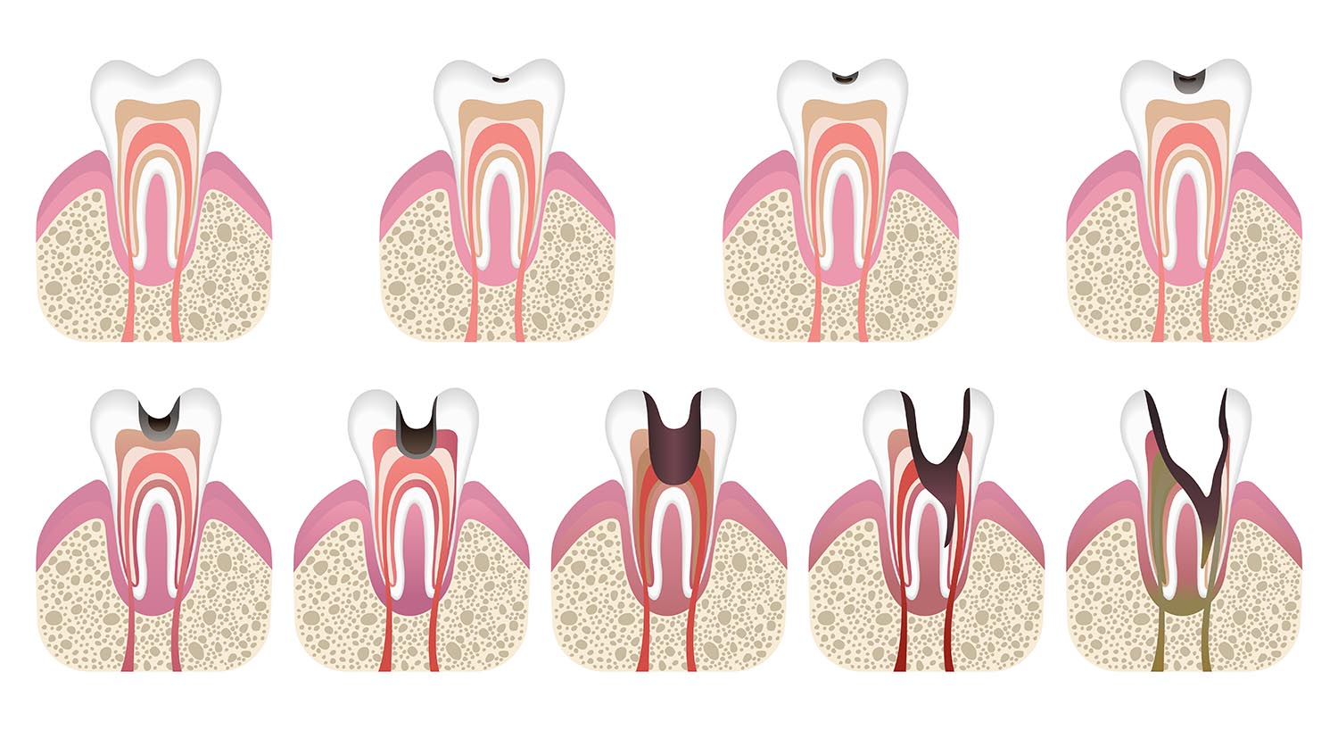 Understanding the Stages of Tooth Decay: Protecting Your Smile